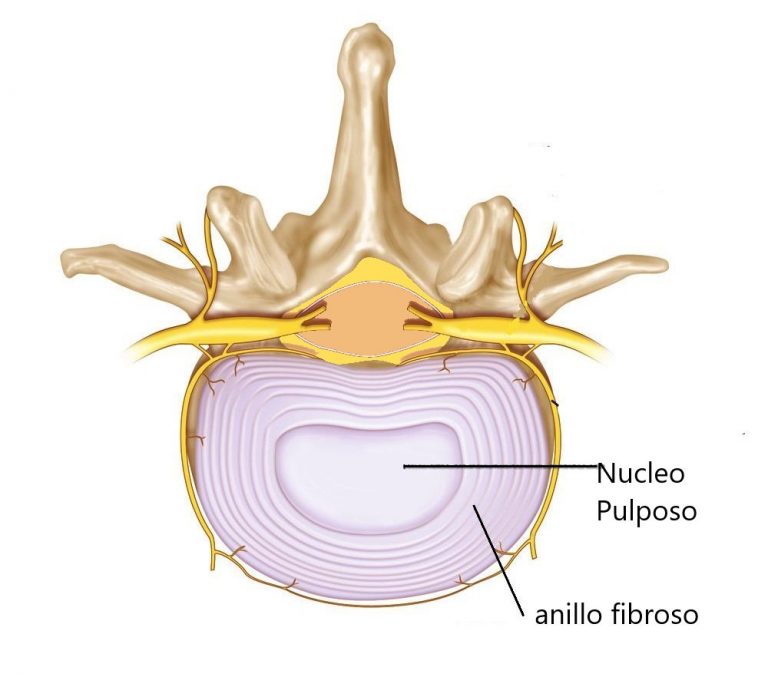 Ruptura del anillo discount fibroso