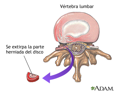 Imagen de hernia discal