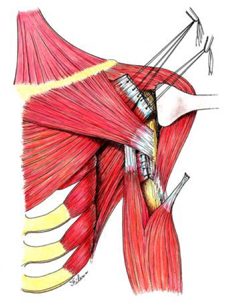 Transferencia tendones hombro