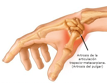 Rizartrosis