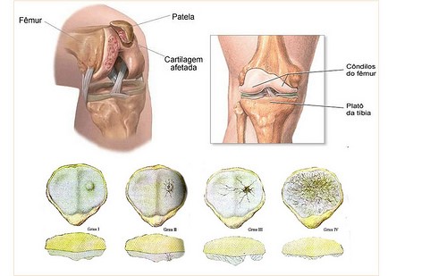 Escala de grados de condromalacia