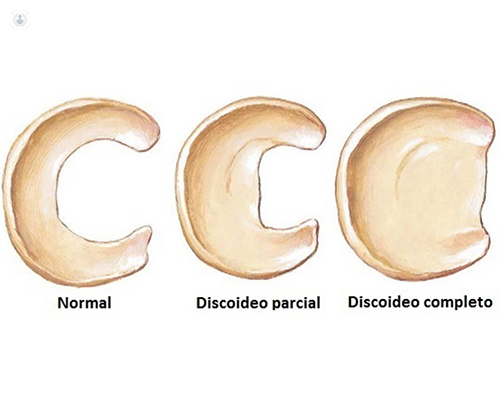 Menisco discoide