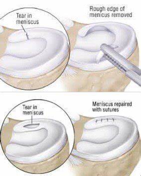 Reparacion Menisco