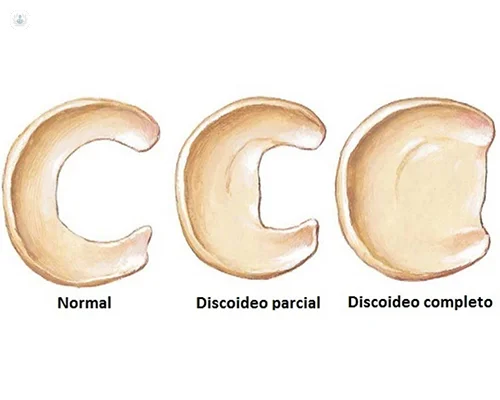 menisco-discoide - Dr Navas menisco-discoide - Dr Navas