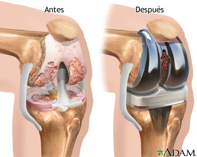 protesis rodilla Protesis rodilla - Dr Navas