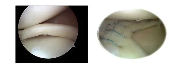 Sutura meniscos por artroscopia - Dr Navas Sutura meniscos por artroscopia - Dr Navas