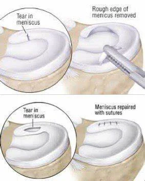 Reparacion meniscos Dr Navas Reparacion meniscos Dr Navas