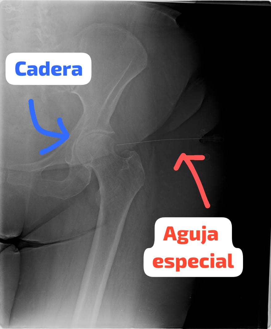 Punción cadera Foto de Dr Fernando Navas Traumatólogo